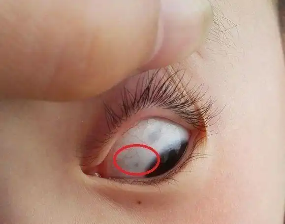 宝宝眼白有"黑点",多半是这3个原因,家长不必太慌张
