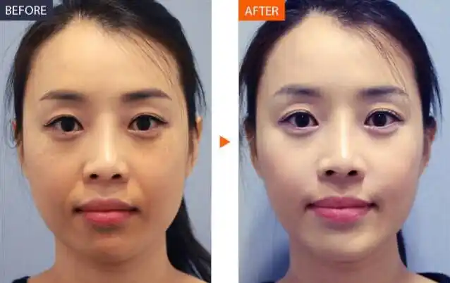 吉林市铭医整形治疗肤色晦暗对比照想要改善肤色暗沉,那就要进行时下