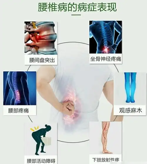 腰椎间盘突出的症状有哪些?是否可以能根治?_治疗_腰部_肌肉