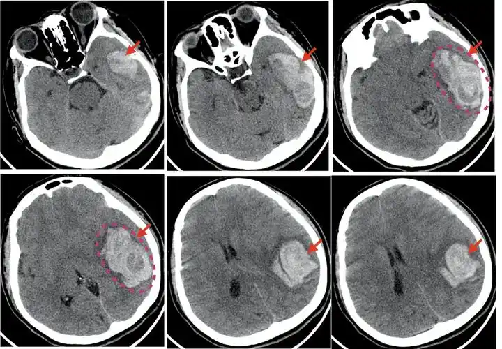 患者入院头颅ct显示为左侧颞枕叶脑出血,出血量大