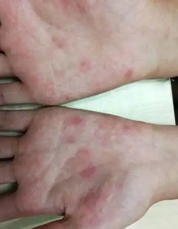 艾滋病人皮肤黑斑 - 搜狗图片搜索