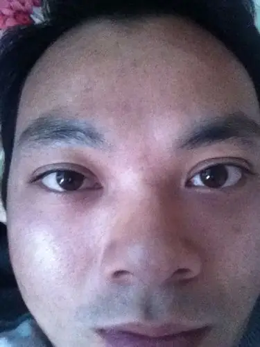 甲亢三项都查过,没有任何问题,眼睛在突出