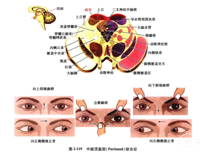 中枢神经系统疾病定位诊断图解脑干精讲