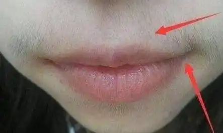 唇毛多是怎么回事啊 女性唇毛多怎么办?