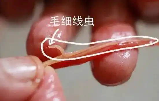 科普异尖线虫病科普知识