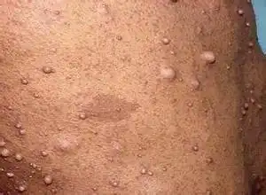 为主要发生于婴儿和幼儿指(趾)部的特殊肌纤维母细胞增生