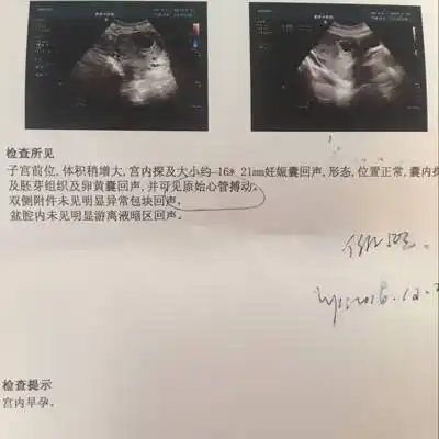 怀孕五十天这样的孕囊大小正常吗