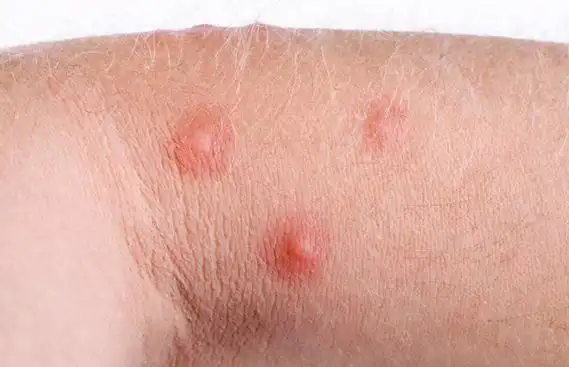 一家3口皮肤痒了半个月,却查出hpv感染,没想到原因在妈妈身上