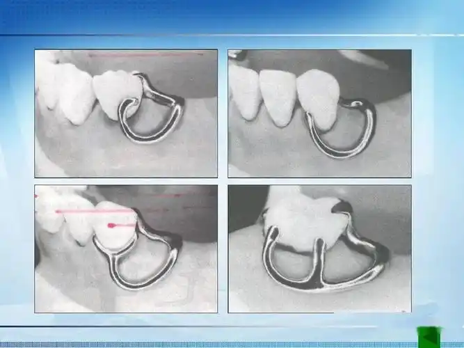 可摘局部义齿卡环的种类