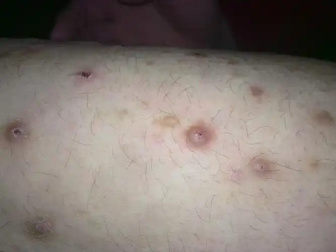 我怀疑我得了皮肤癌?