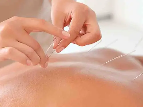 针灸治疗中风偏瘫绝技