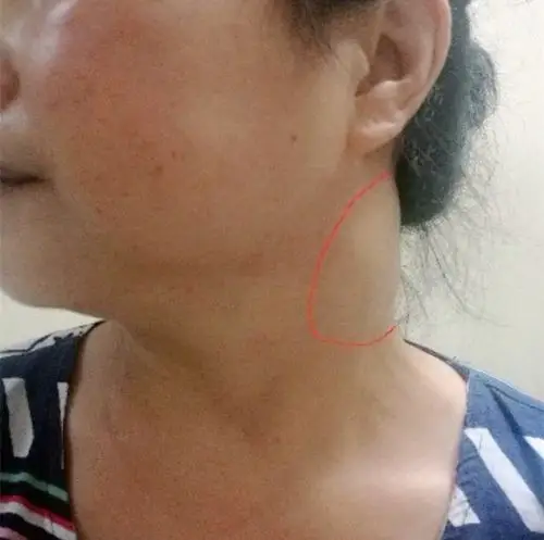 硬纤维瘤病也称为侵袭性纤维瘤病,是原发于肌腱腱膜的一种良性肿瘤