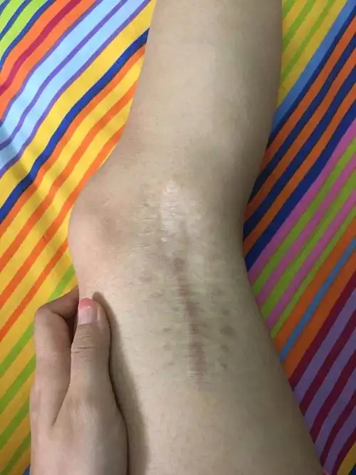 人们看到一个腿上有烫伤疤痕的女孩会怎么想呢