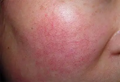 红血丝形成的原因如何护养红血丝