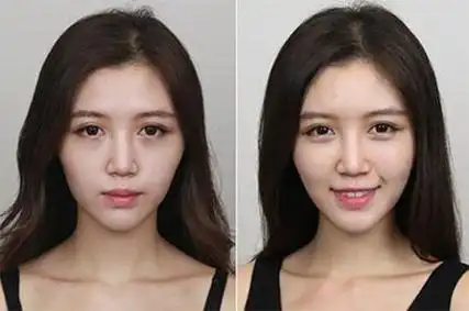 分享我在海南美媛整形医疗美容医院做的玻尿酸丰苹果肌的术后效果图