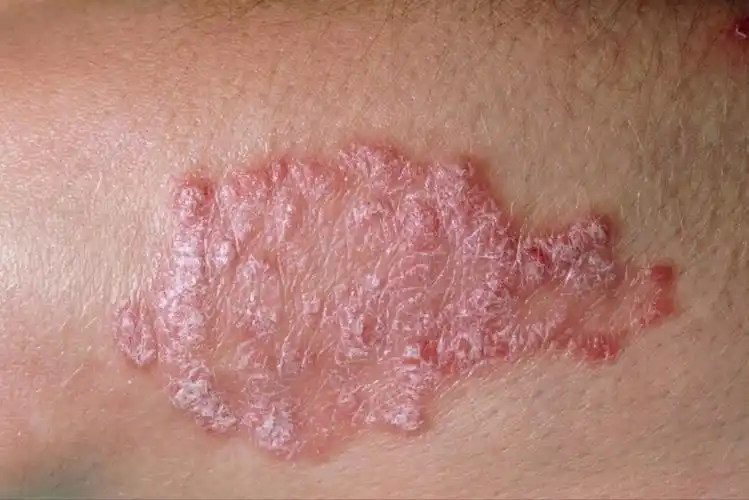 牛皮癣的治疗方法(牛皮皮癣用什么药治疗) 牛皮癣的治疗方法 第1张