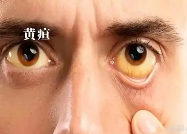 肝功能出现问题,都会导致黄疸,7大问题诊断黄疸