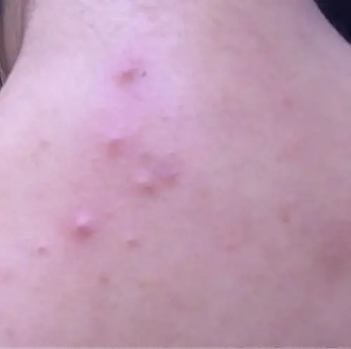 现在怀孕5个多月了,是不是湿疹?还是内分泌