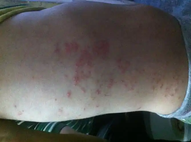 儿童脓疱型银屑病实例,求解答