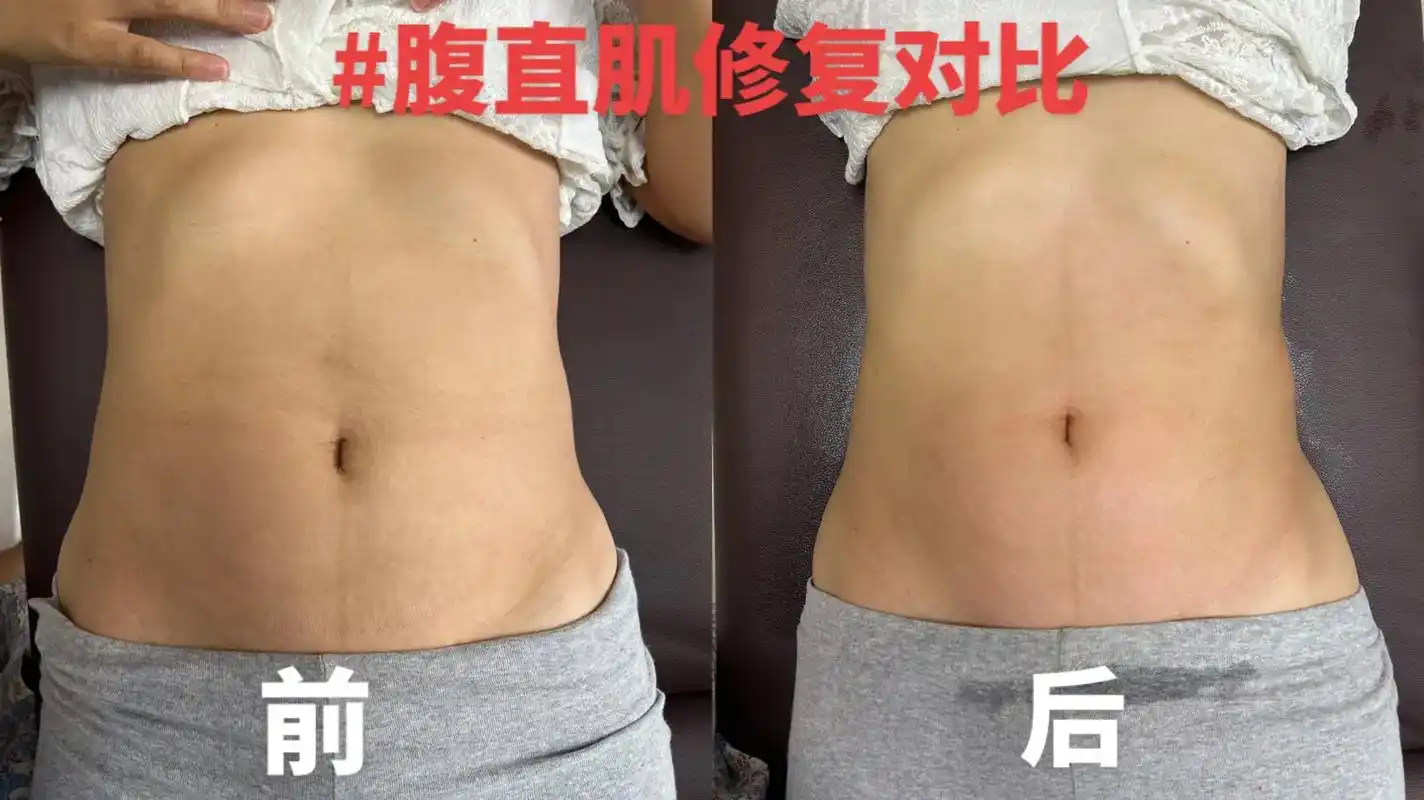 腹直肌修复一定要做吗