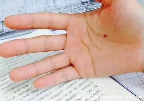 朱砂痣是长在身上的红色小血点