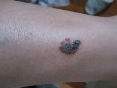 鳞状皮肤癌的图片_有来医生