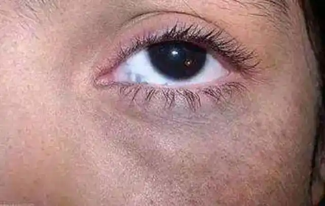 肝炎和肝硬化患者的人,都有一张又黑又暗的脸,而且面部消瘦,皮肤干燥