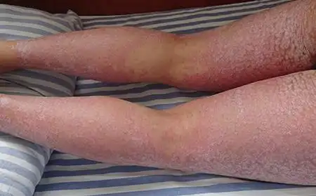 大腿内侧银屑病癣图片症状怎么治疗及药物