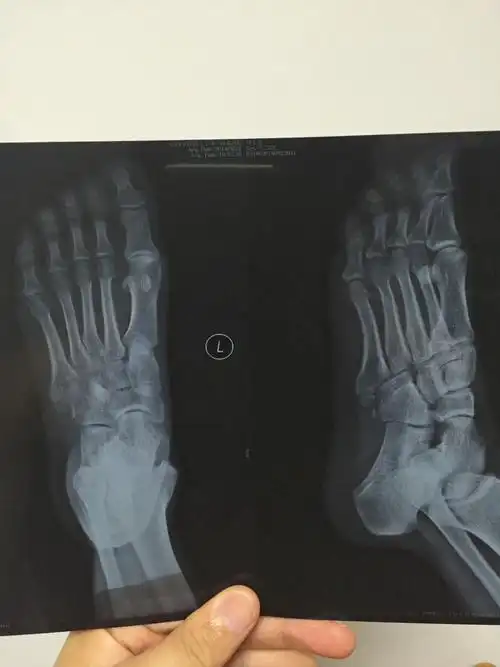 医院拍了个dr片子,诊断第五基底部骨折,然后医生说骨头已经在慢慢生长
