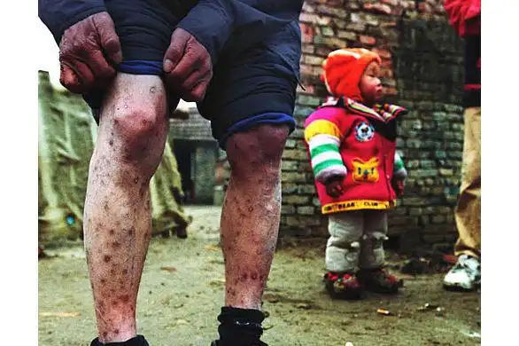 [贴图]艾滋病人真实照片[9p][慎入]