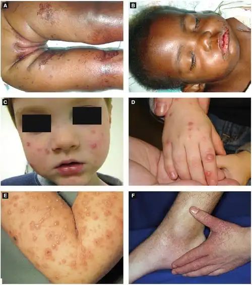 childhood infectious diseases