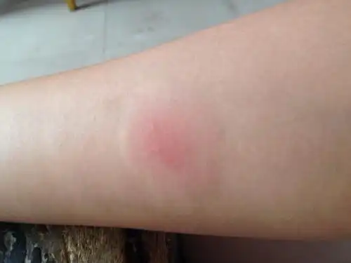 注射结核菌素50小时左右,请问这是阳性吗?我是肺结核吗?