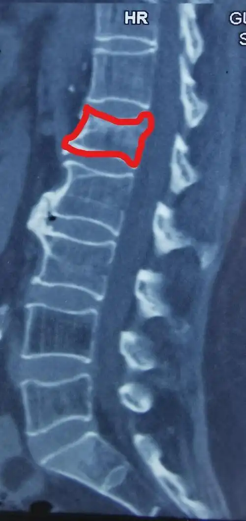 骨质疏松腰椎压缩性骨折"保守治疗"——要慎重选择!