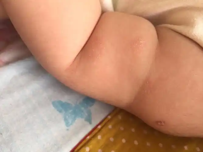 该怎么治?为什么会起这样的癣?