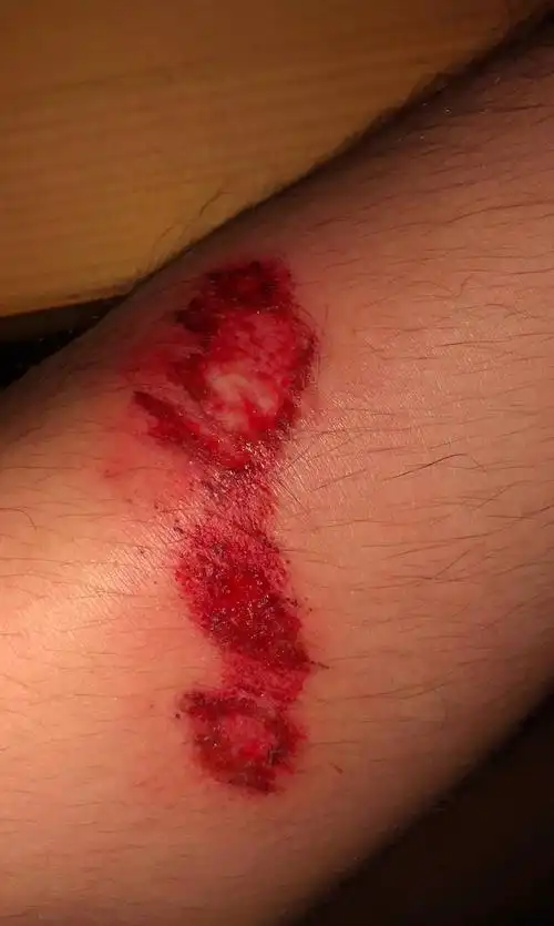 问:前两天摔了一跤,结果腿就成这样了,上面有一层粘液,我该怎么处理