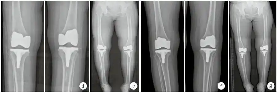 应用缩小胫骨平台截骨技术矫正膝内翻畸形的探讨