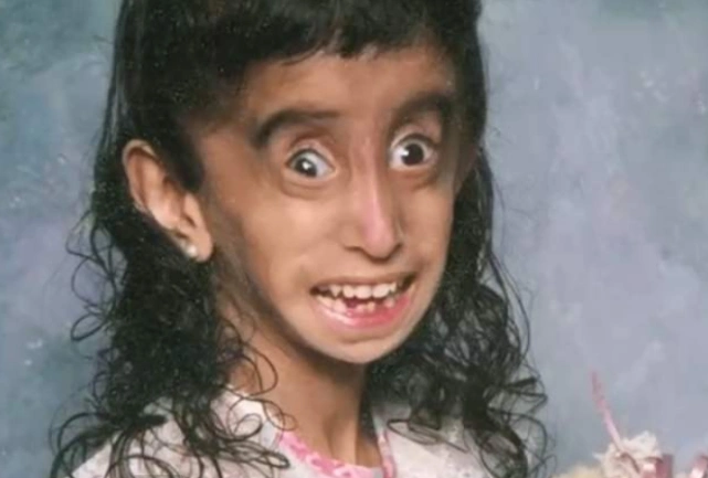 世界上"最瘦"的女人,身高一米58体重仅20千克,堪称行走的竹竿