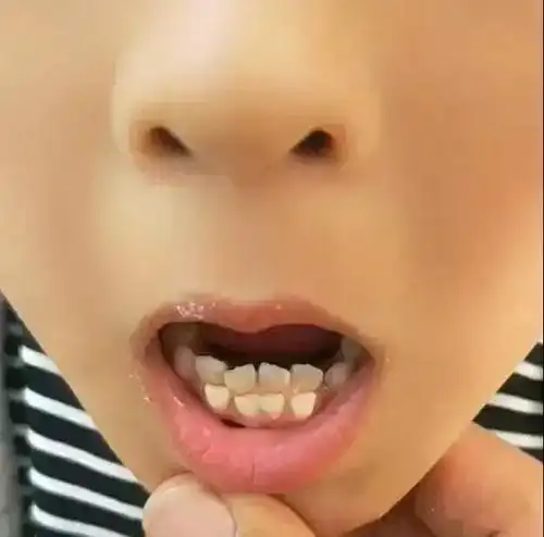 孩子为啥会长"双排牙"?跟这些坏习惯有关系,家长要了解