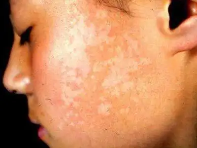 单纯糠疹有哪些病症表现