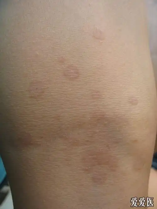 这个皮肤病是花斑癣吗