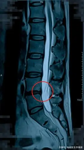 病例分享:明明腰不痛,怎么就腰椎间盘突出了呢?