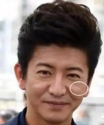 印第安纹图片是什么样的,泪沟凹陷严重都到脸颊了是印第安纹吗?