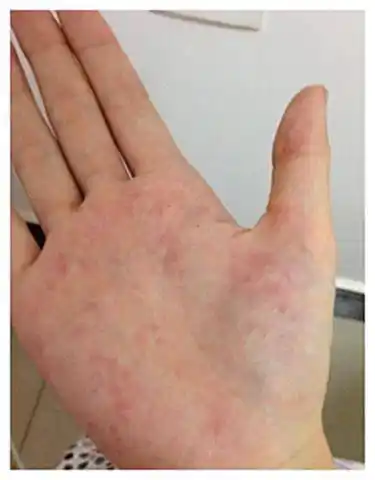 面条是肝癌的导火索提醒不想肝受伤这些食物及早远离