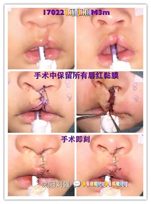 唇裂一期手术后如果能够达到理想的效果当然是众望所归的.