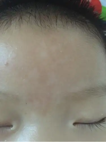 急麻烦各位帮我看看宝宝额头长的是什么