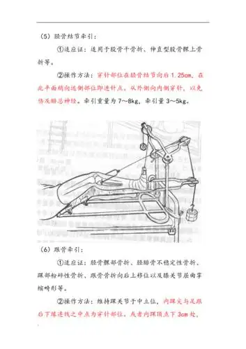 骨牵引术(非常实用)