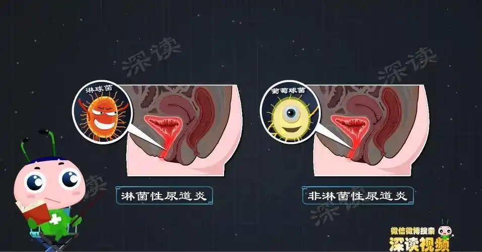 原创啪后尿痛不在意白带多没事尿道炎症别大意这些症状小心尿道炎