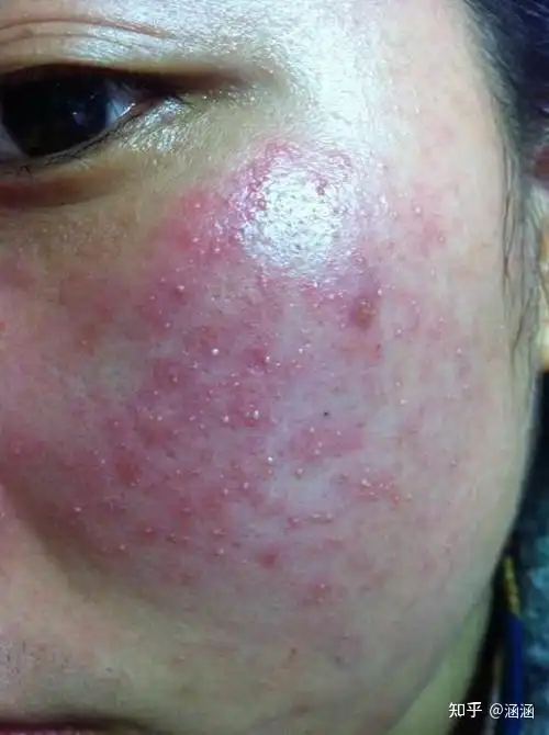 敏感肌好了 - 知乎