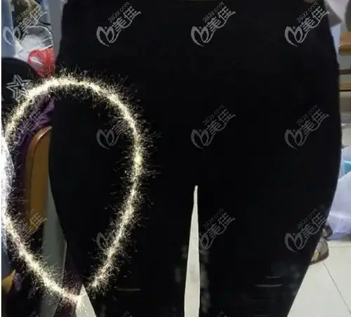 大腿外侧突出显得腿粗