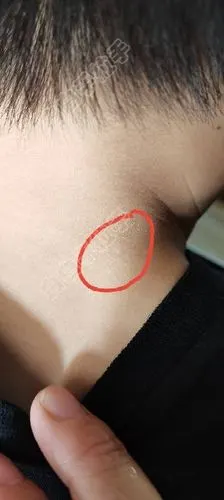 请问李博士,小孩脖子上这个白点是白白吗?